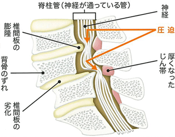 脊柱管狭窄症２gif.gif