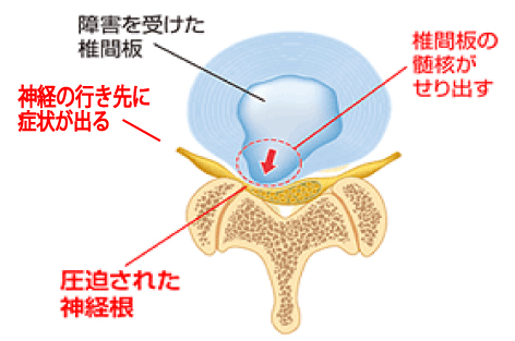 椎間板ヘルニアのイメージ