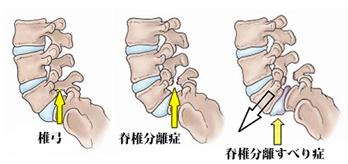 腰椎分離すべり症のイラスト