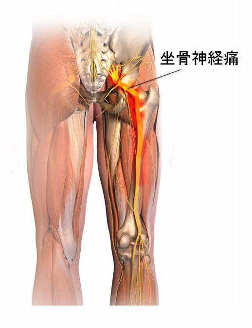 坐骨神経痛の発生場所