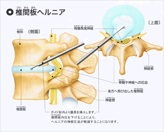 椎間板ヘルニアのイメージ